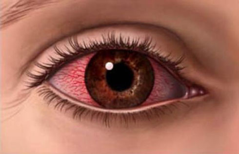 olho-seco-hiperemia