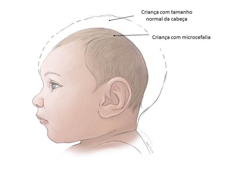 microcefalia