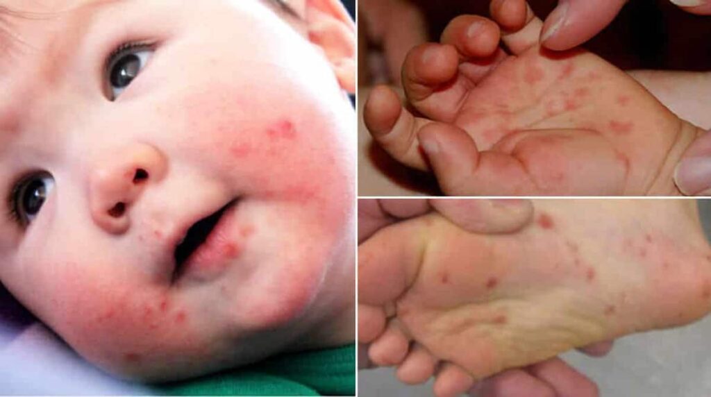 Pediatra potiguar alerta para surto da doença mão pé boca