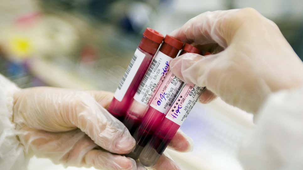 Cientistas desenvolvem exame de sangue capaz de detectar câncer de pulmão precocemente